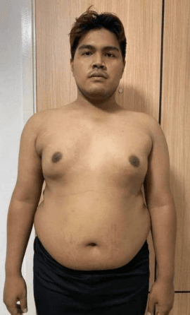 ภาพก่อนเปลี่ยนแปลง — เคสลดไขมัน