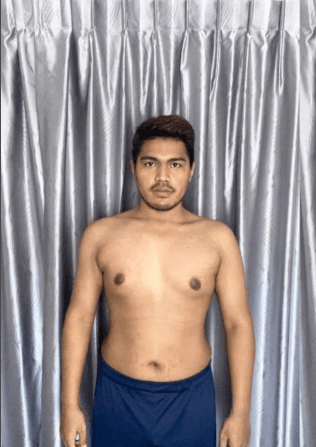 ภาพหลังเปลี่ยนแปลง — เคสลดไขมัน